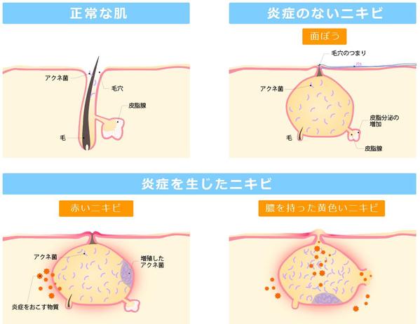 医療イラスト作成