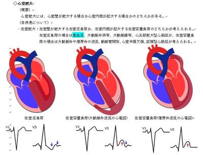 心室肥大についてまとめました