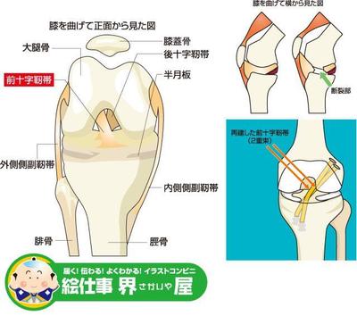 前十字靭帯損傷