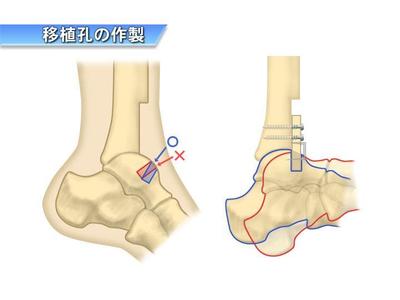 手術説明イラスト