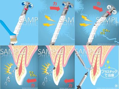 歯科 治療説明用アニメーション