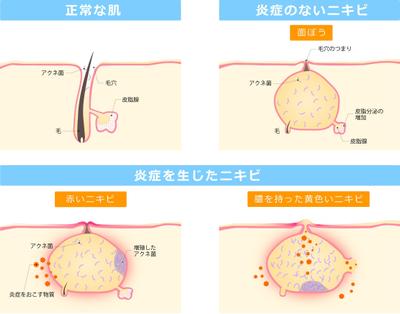 【イラスト】ニキビのイラスト Illustration of acne