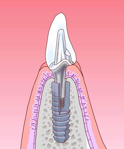 インプラント