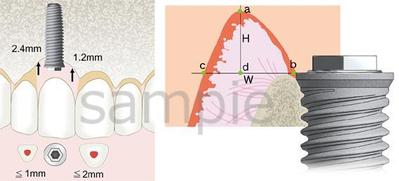 歯科、インプラントイラスト