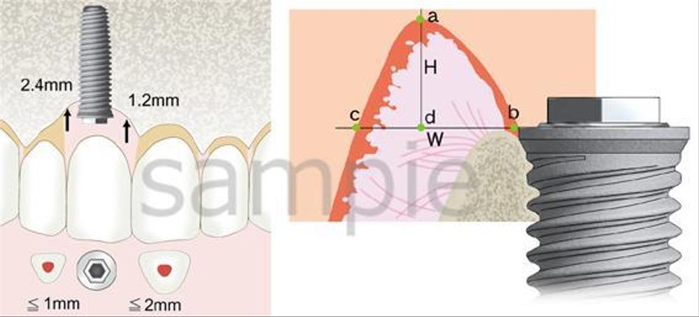 歯科、インプラントイラスト
