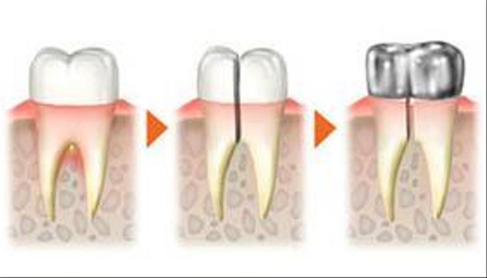 歯科、金をかぶせる仕方