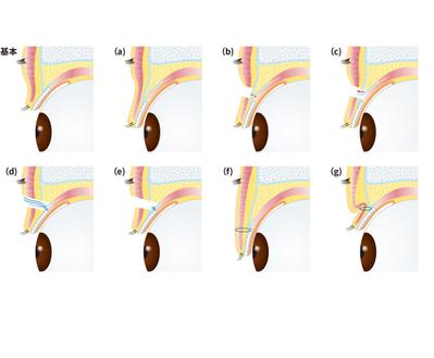 眼瞼下垂の手術イラスト制作