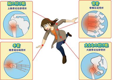 骨粗しょう症　骨折箇所説明イラスト