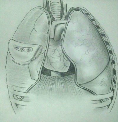 肺の病気の緊急処置