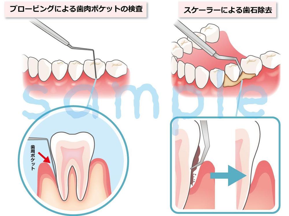 歯周メンテナンス