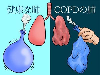 疾患解説（慢性閉塞性肺疾患）のイラスト２COPDの肺