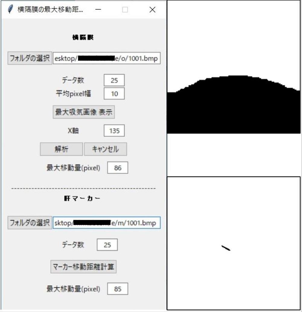 2値化された横隔膜の移動距離計測プログラム