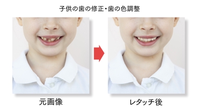 子供の歯の修正