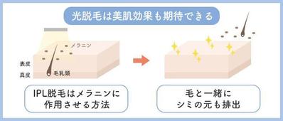 光脱毛の特徴がわかるインフォグラフィックを作成いたしました