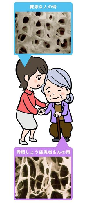 TagamiGames (TagamiGames)さんの骨粗鬆症イラストの書き直しへの提案