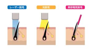 YoshimiM (marulemon7)さんの【選定確約】男性向けメディア用「脱毛イラスト」の制作依頼への提案