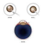 Hachibun18 (Hachibun18)さんのカタログ・説明資料用の眼球及び眼科メスのテクニカルイラストへの提案