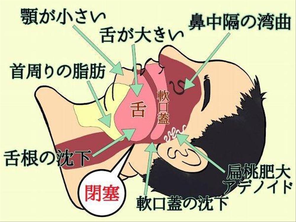 クリニックの疾患解説ページ（睡眠時無呼吸症候群）のイラスト