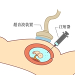 とりすけ (torisuke57)さんの産科診療のイラスト　羊水検査・絨毛検査への提案