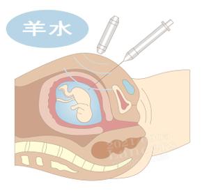 産科診療のイラスト 羊水検査 絨毛検査の事例 実績 提案一覧 Id イラスト制作の仕事 クラウドソーシング ランサーズ