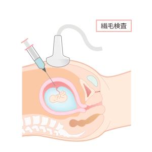 産科診療のイラスト 羊水検査 絨毛検査の事例 実績 提案一覧 Id イラスト制作の仕事 クラウドソーシング ランサーズ