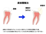 kazan (empnefsi)さんの歯科治療の中の『神経を残す治療』の説明資料への提案
