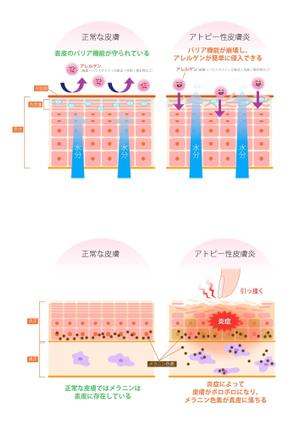 アトピー性皮膚炎のメカニズムイラスト作成 継続依頼有 の事例 実績 提案一覧 Id イラスト制作の仕事 クラウドソーシング ランサーズ