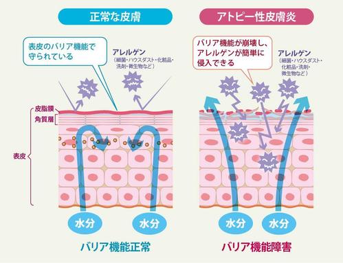 Ohi Ruca Drawingsさんの事例 実績 提案 アトピー性皮膚炎のメカニズムイラスト作成 継続依頼有 Ohi Ruca D クラウドソーシング ランサーズ