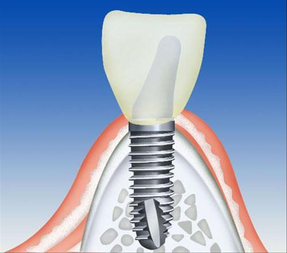 インプラント治療のイラスト作成依頼　　14点