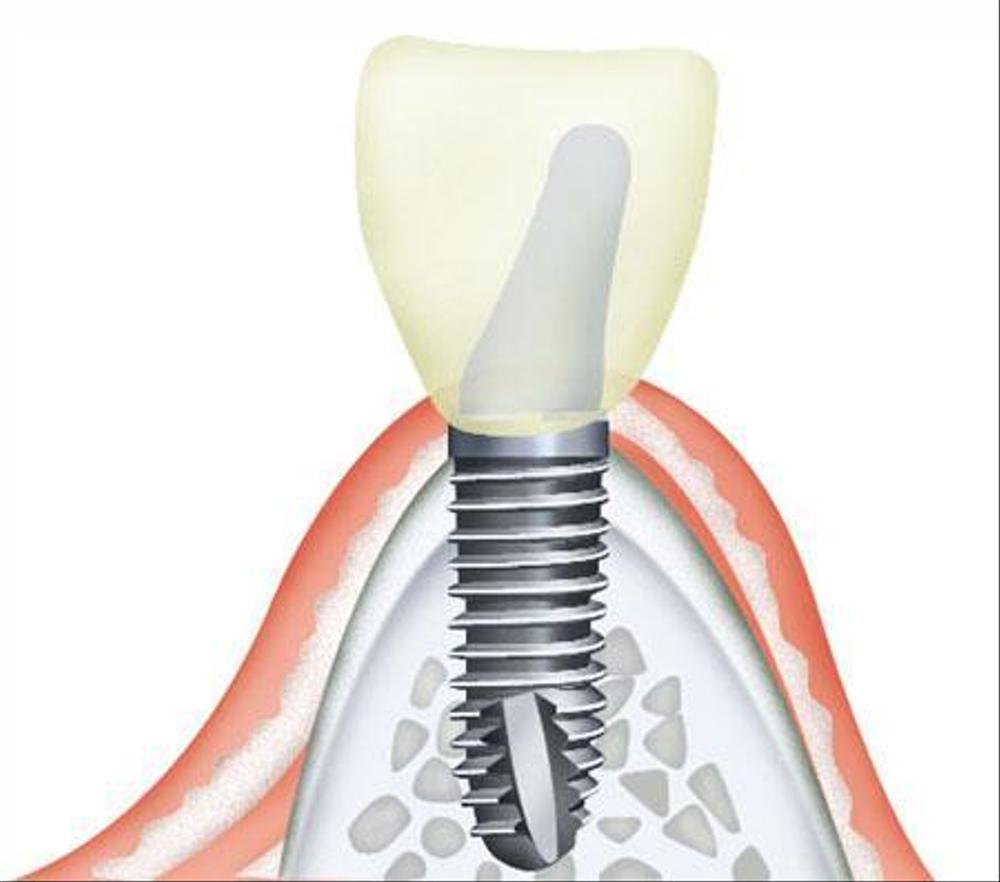 インプラント治療のイラスト作成依頼　　14点