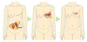 鈴丸 (suzumarushouten)さんの乳房再建術の様子がよくわかるイラスト　複数枚への提案