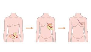 二階堂ちはる (umako_takitate)さんの乳房再建術の様子がよくわかるイラスト　複数枚への提案