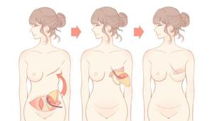 ム ()さんの乳房再建術の様子がよくわかるイラスト　複数枚への提案