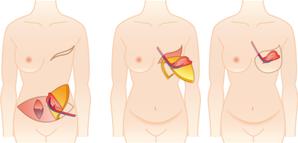 七井 (DDFF589)さんの乳房再建術の様子がよくわかるイラスト　複数枚への提案