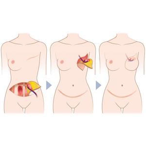 mamikaru (mamikaru)さんの乳房再建術の様子がよくわかるイラスト　複数枚への提案